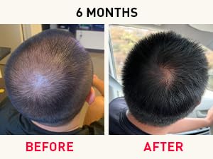 Before and After Photos at 6 Months. Results may vary 